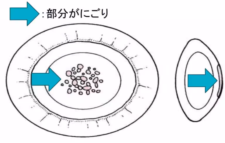 後嚢下白内障（こうのうかはくないしょう）​