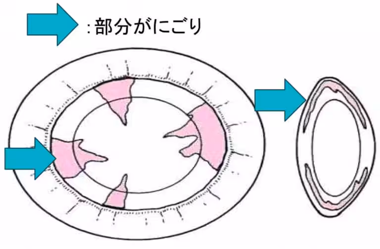 皮質白内障（ひしつはくないしょう）